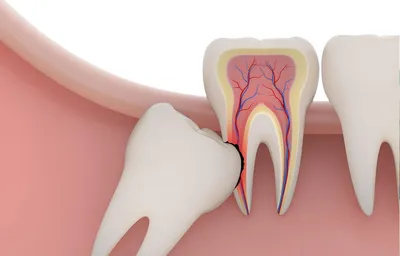 Как и зачем удалять зубы мудрости - стоматологический блог Sirius-Dent