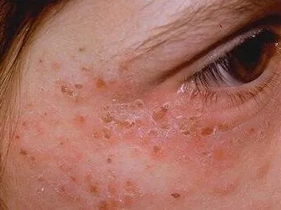 Рука человека, царапающая зуд на чувствительной к красному краску коже, как  симптомы аллергии на продукты питания или вредителей | Премиум Фото