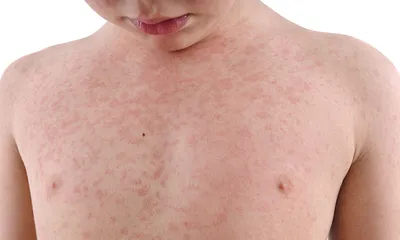 Аллергия на коже лица: виды аллергической сыпи у взрослого, лечение и фото,  чем лечить, снять реакцию, что делать с прыщами, как убрать и избавиться,  причины сильных высыпаний на шее