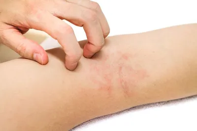 Сыпь на теле: причины высыпаний на коже, виды, симптомы, диагностика и  лечение
