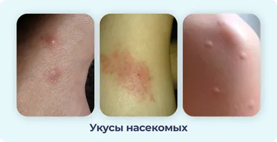 Сыпь на теле: на лице, туловище, руках - Основные причины появления сыпи на  коже - Лечение высыпаний на коже