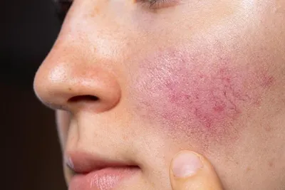 Купероз на лице — лечение купероза | Медицинский центр Эра