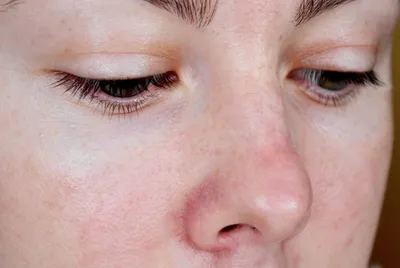 Сосуды на лице (фото до и после)
